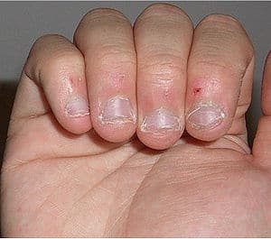 bitten nails